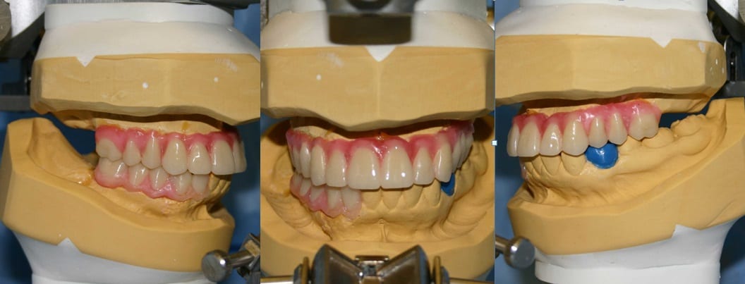diagnostic wax waxup digital models dentistry patient study treatment