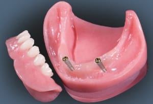 implant overdentures dentures partials cosmetic final