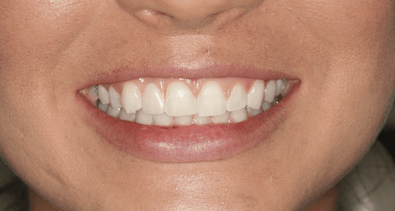 The ‘Flipper’:  A Temporary Tooth