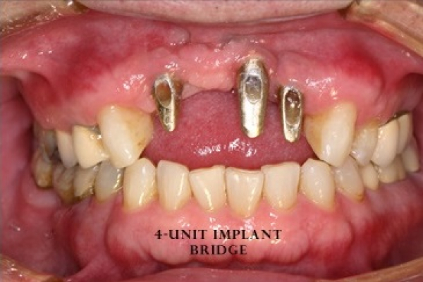 implant2